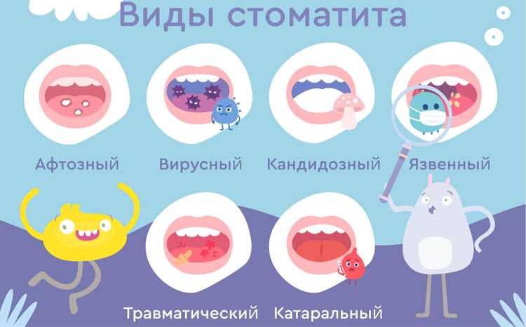 Что такое стоматит? Чем опасен и как лечить Что такое стоматит? Чем опасен и как лечить