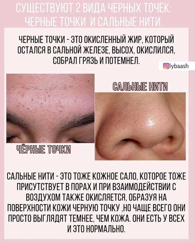 Как избавиться от чёрных точек