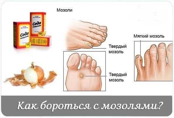Как лечить натоптыши и мозоли
