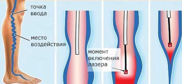 Как лечится варикозное расширение вен?