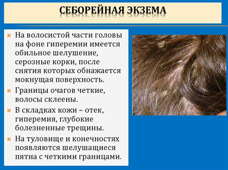 Как вылечить себорейный дерматит на голове?