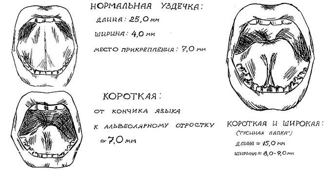 Как понять, что у малыша не всё в порядке с подъязычной связкой?