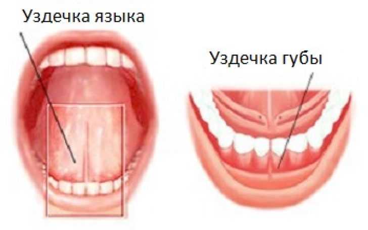 Короткая уздечка языка у ребенка - как определить Короткая уздечка языка у ребенка: как определить