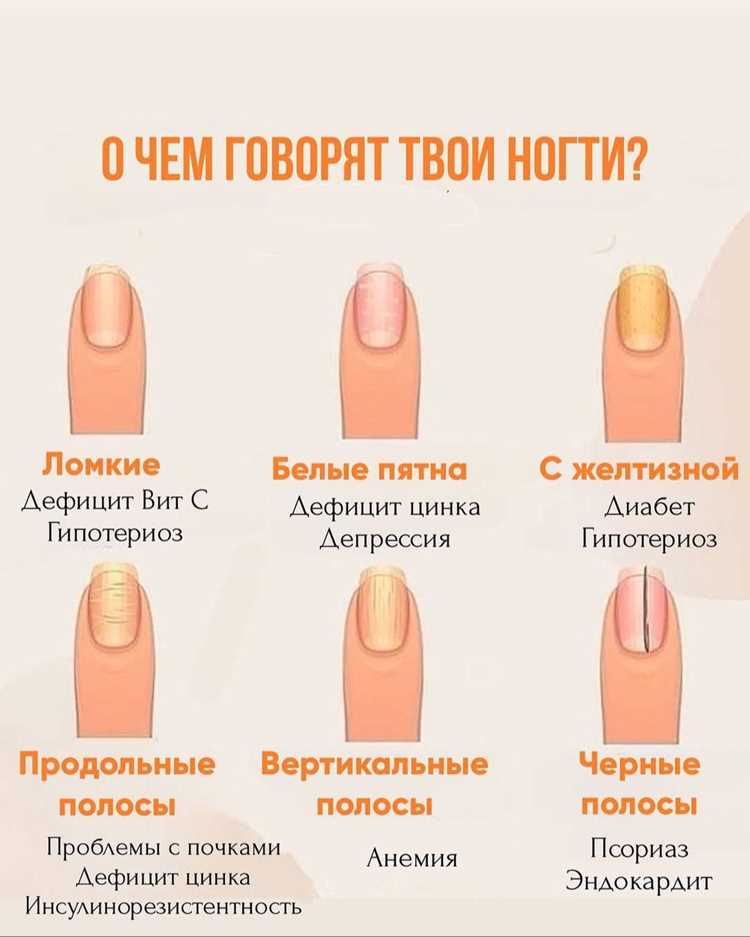 Какие изменения цвета ногтей сигнализируют о внутренних нарушениях