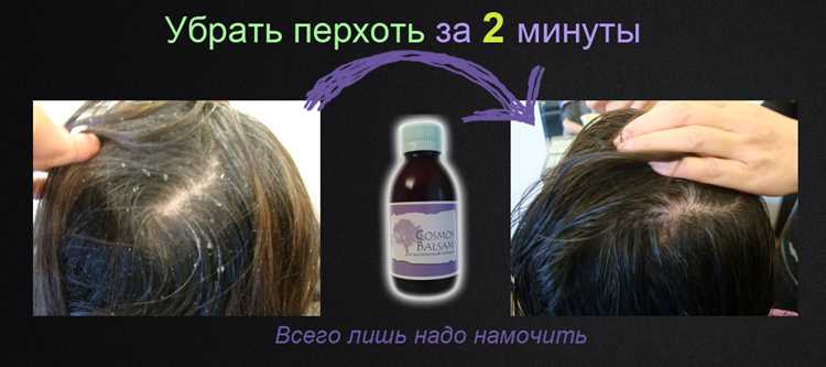Почему от перхоти так тяжело избавиться, и какие средства самые лучшие Почему от перхоти так тяжело избавиться, и какие средства самые лучшие