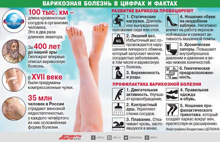 Профилактика варикоза: секреты здоровья и красоты ног