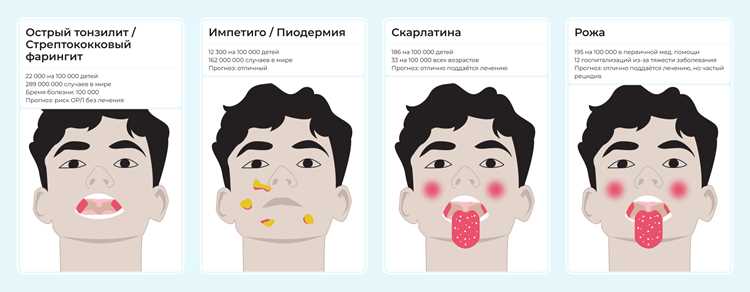 Скарлатина у детей – симптомы